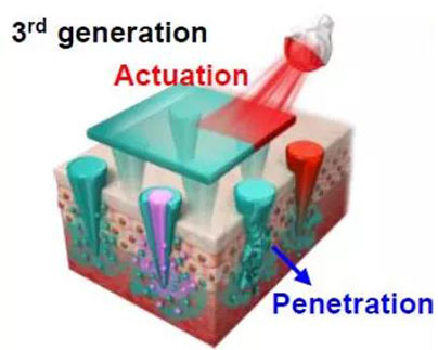 第三代：通过微针介导的皮肤层破坏和微针伴随的各种功能增强药物转运.jpg